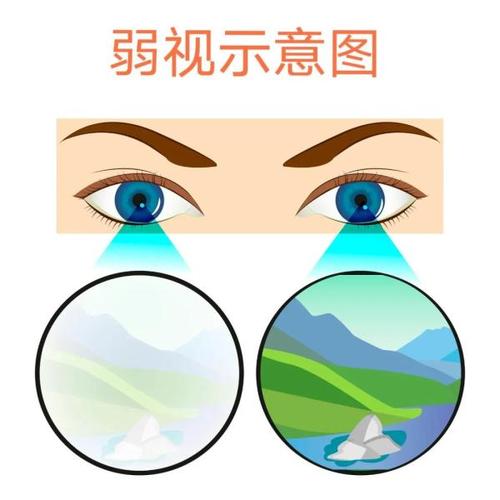 宜宾弱视治疗最佳时间是几岁？